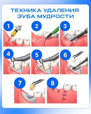 Зубы мудрости: ювелирное удаление с VLADMIVA.